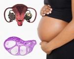 Die Wahrscheinlichkeit einer Schwangerschaft mit dem Syndrom der polyzystischen Eierstöcke. Ist es möglich, mit dem Syndrom der polyzystischen Eierstöcke schwanger zu werden?