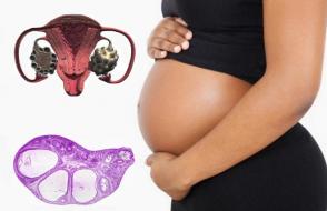 Sannolikheten för graviditet med polycystiskt ovariesyndrom. Är det möjligt att bli gravid med polycystiskt ovariesyndrom?
